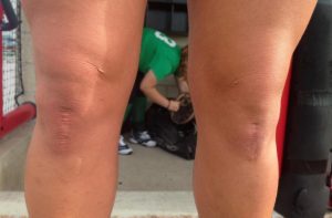 Annie Fleming bares her scars from two ACL surgeries